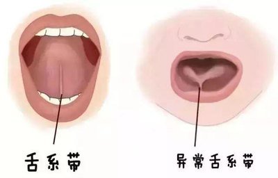 舌头下面的“系带”有啥用？舌系带短会影响宝宝说话？