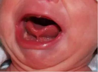 小孩说话不清楚是和舌头有关系吗?可能是宝宝舌头这里有问题！